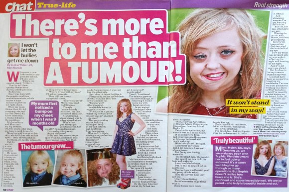 Sophia was born with neurofibromatosis, which caused a large facial tumour to grow. She told Chat why she refuses to let the bullies get her down. 